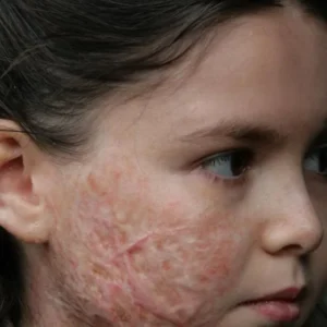 سوختگی گونه بچه